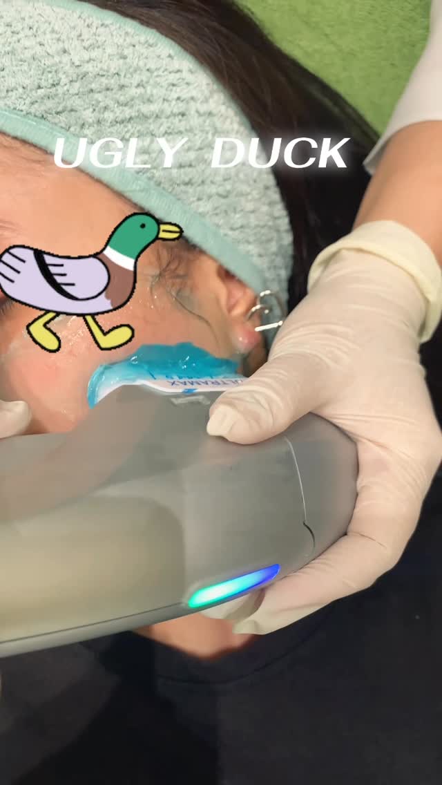 HIFU Ultramax 7D ยกกระชับหน้า V-Shape