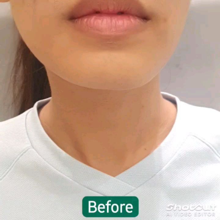 ฟิลเลอร์คาง ปรับรูปหน้าให้ได้สัดส่วน