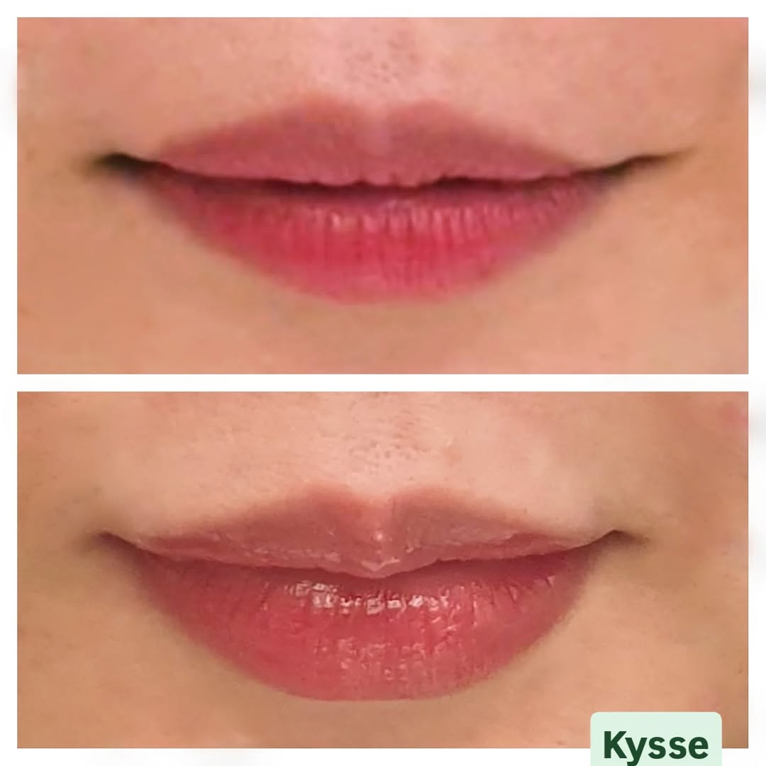 เติมปาก Restylane Kysse จากสวีเดน