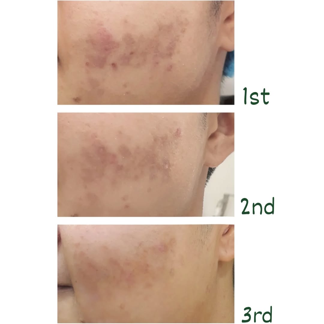 ผลลัพธ์การรักษาหลุมสิว ครั้งที่ 1, 2, 3 ดีขึ้นชัดเจน