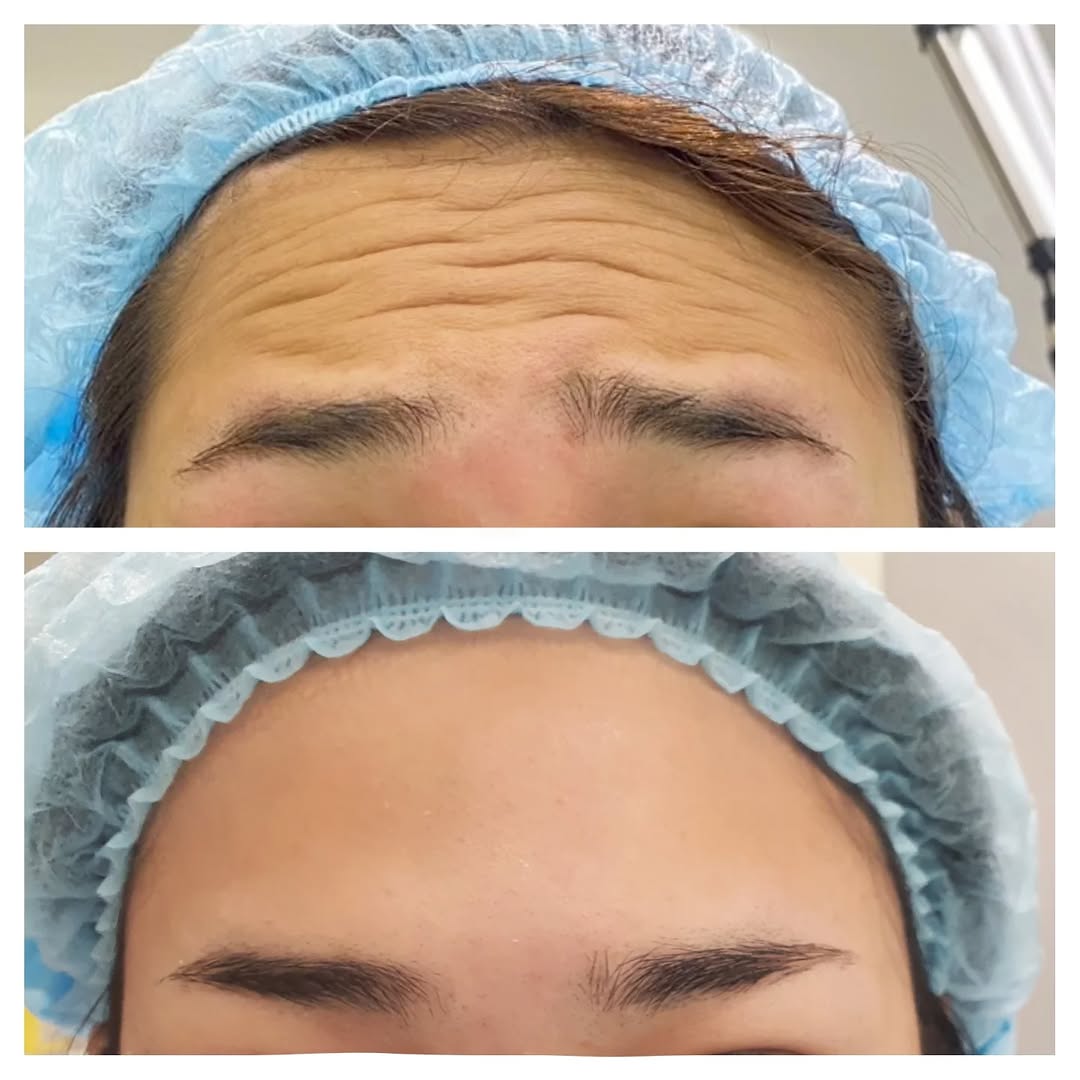 ก่อน-หลัง โบท็อกซ์ลดริ้วรอยหน้าผาก